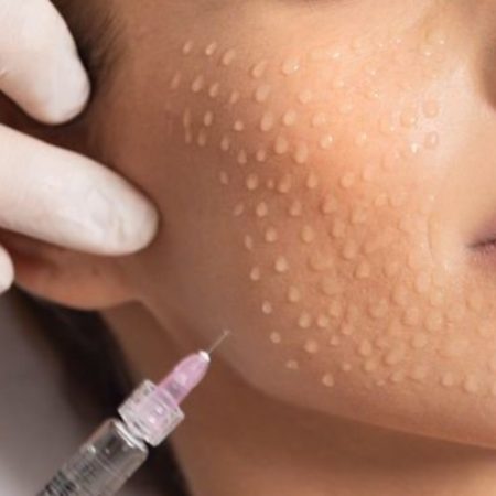 Biorevitalizacija